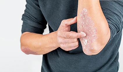 Produk untuk Kulit Psoriasis